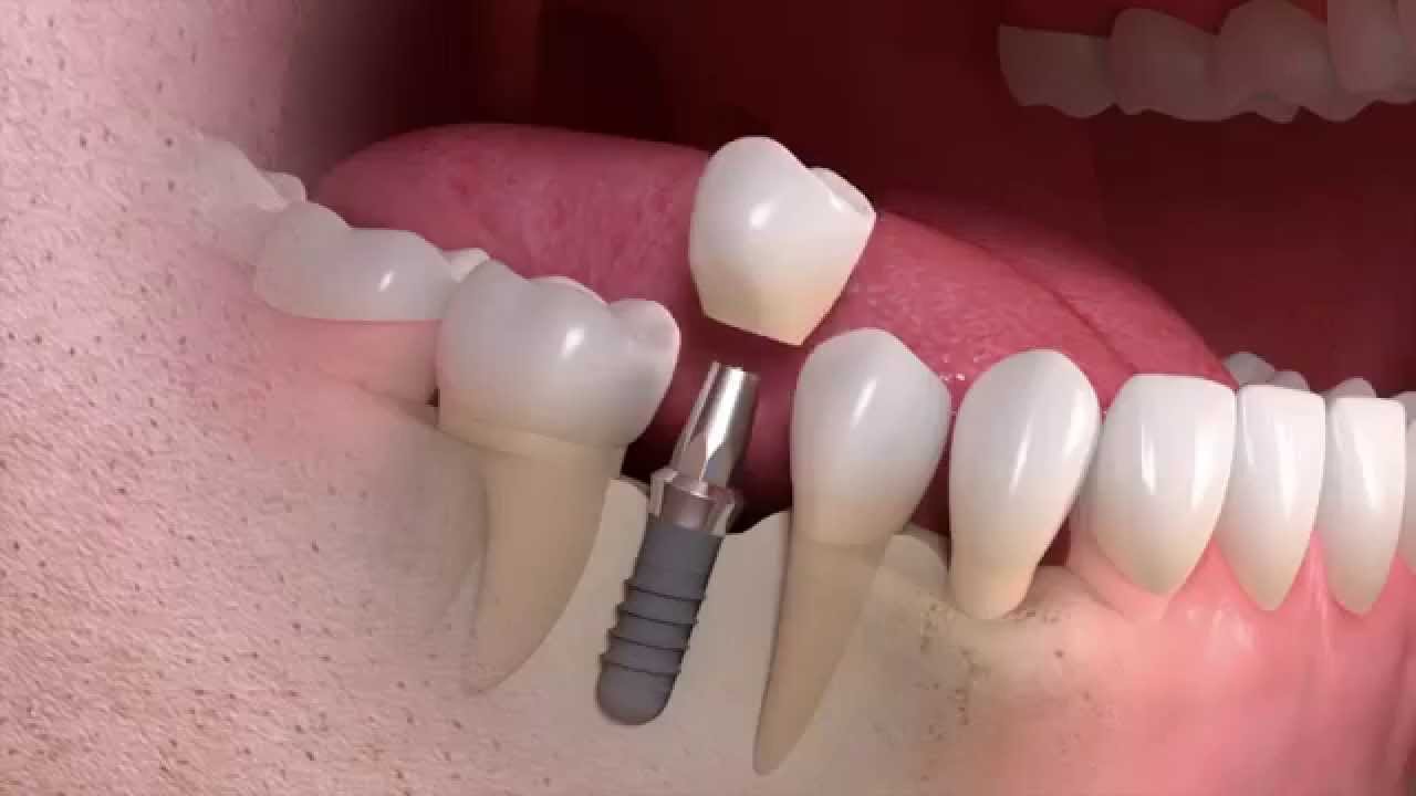 Dental Implants