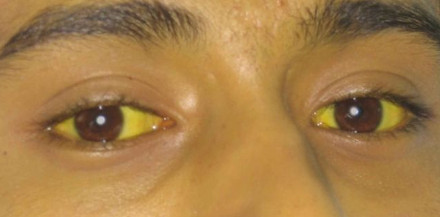 Cope With Yellow Eyes With Natural Materials