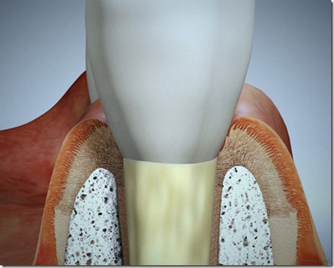 implante dentario