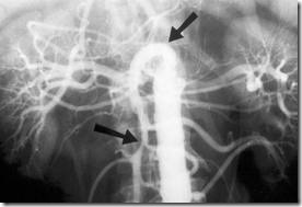 angiongraphy for intestinal ishemia