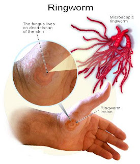 Ringworm Treatments, Ringworm Symptoms