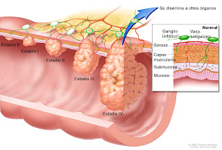 cancer de colon