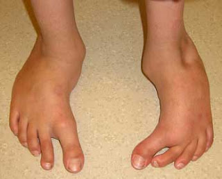 Metatarsus adductus - Images, stretching exercises, Shoes, Clubfoot