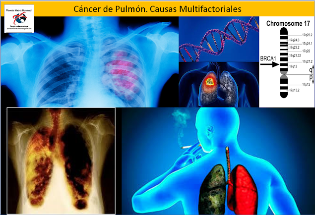 El-cancer-de-pulmon-puede-tener-origen-en-causas-geneticas-o-ambientales
