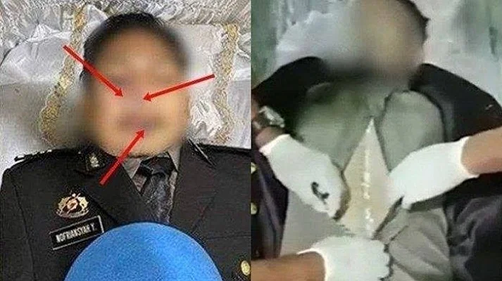 NGERI! Ada Organ Tubuh Brigadir J yang Hilang Saat Autopsi, Ahli Curiga Mengarah ke Kejahatan Pencurian Organ