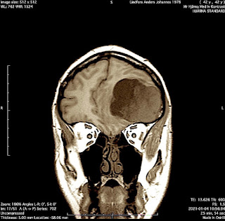 Meningeom är en oftast godartad intrakraniell tumör som utgår från hjärnhinnorna.