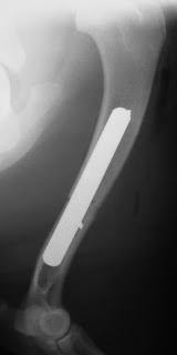 Ακτινογραφία βραχιονίου μετά την οστεοσύνθεση με μεταλλική πλάκα και κοχλίες