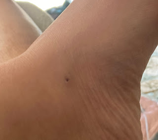 蚊の刺され傷を塩で治した跡