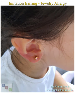 Fake Jewelry Allergies, Imitation Earring Allergy, Fake Jewelry Rash on Ear?, Can Artificial Jewelry Cause Infections?,  Itchy Red Rash After Wearing Fake Earrings