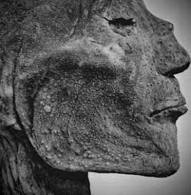 Un dermatólogo en el museo: Ramsés V, el caso de viruela más antiguo