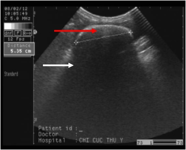 Sỏi bàng quang trên chó cái:Viên sỏi (mũi tên đỏ) có hiện tượng tăng âm, kích thước đo được là 5,35 cm, kèm theo đó là vùng bóng lưng (mũi tên trắng).