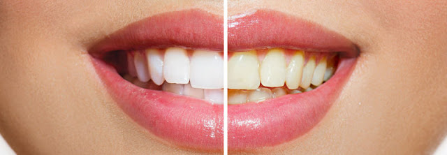 teeth whitening Moonee Ponds