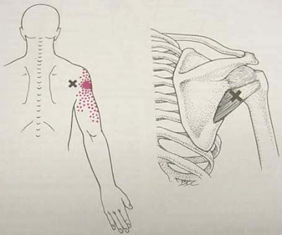 MIOTERAPIA