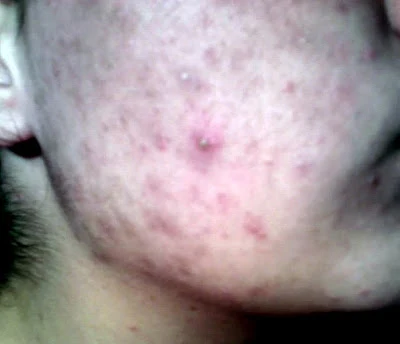 Acne And Pimple And Treatments