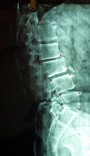 脊椎滑脫, 腰酸治療, 脊椎矯正, 脊椎側彎矯正運動