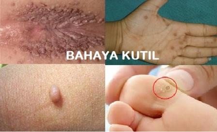 harga obat kutil kelamin