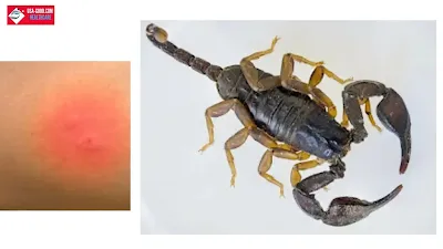 What Is Scorpion Sting?