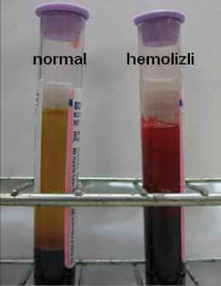 hemolizli ve normal kan örnekleri