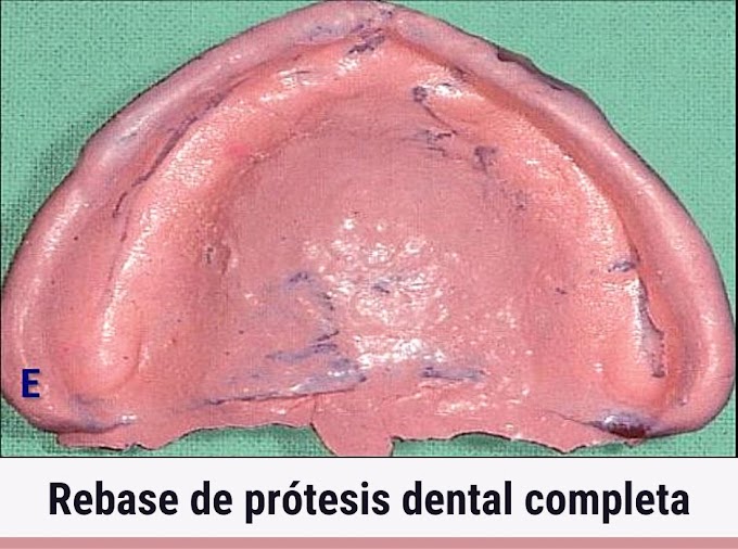 PDF: Rebase de prótesis dental completa en 5 pasos