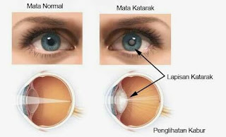 gambat penyebab penyakit mata katarak