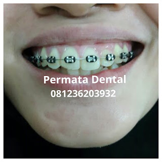 gambar foto behel bracket kawat gigi sebelum dan sesudah perawatan untuk memperbaiki merapikan gigi gingsul gigi miring renggang tonggos berantakan keluar masuk jarang diastema maju mundur tidak rapi tidak beraturan bali denpasar banyuwangi jember tidak rata kocar kacir