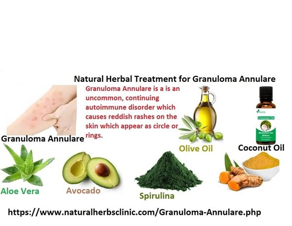 Herbal Treatment for Granuloma Annulare