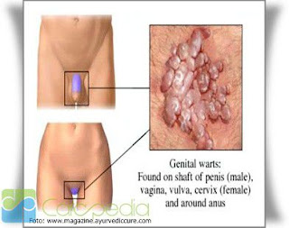 Gambar tanda-tanda penyebab penyakit gonore cara mengobati gonore secara alami