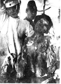 hiroshima-burn-victim-war-crime