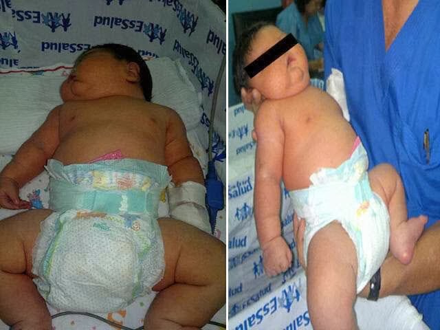Nace superbebé en Iquitos y sorprende a médicos
