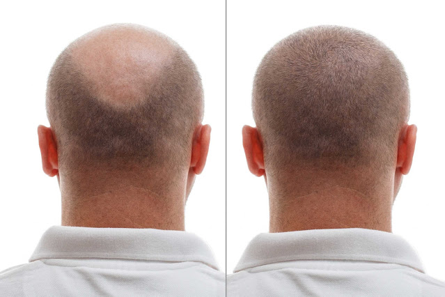 Hair Transplant Clinic in Delhi