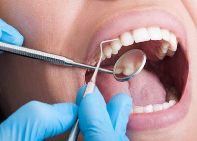 Cạo vôi răng có làm trắng răng không? Thông tin cho bạn 2