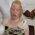 Albinos Killed In Tanzania For Money-Making Rituals