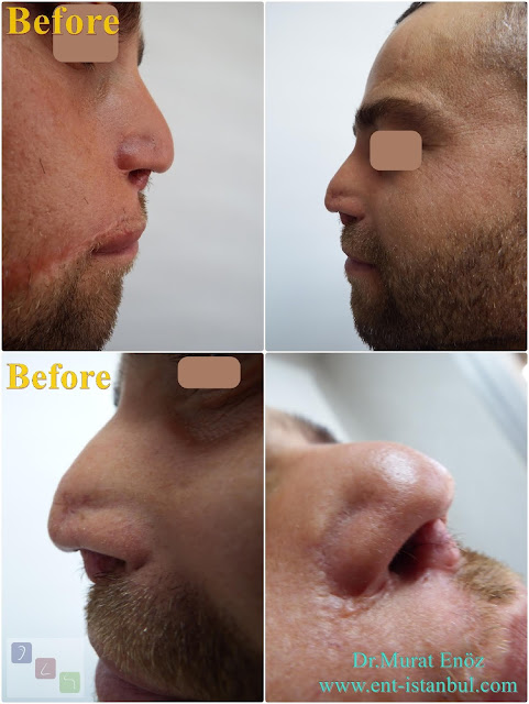 Complicated Revision Rhinoplasty, Revision Nose Job For Male, 8th Nose Operation