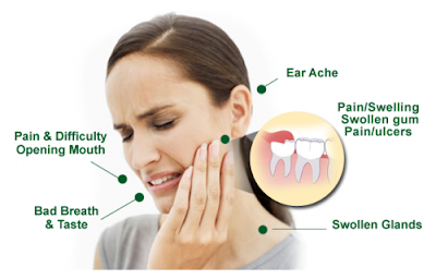 Có nên nhổ răng khôn hàm dưới để chấm dứt cơn đau? 2