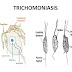 THE TRICHOMONIASIS AND MYCOPLASMA GENITALIUM SYNDROME: TREATMENT AND PREVENTION