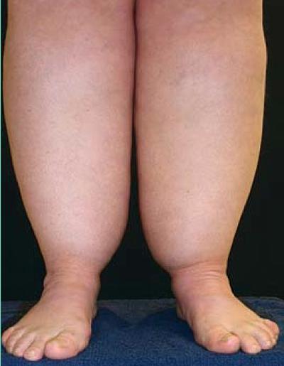 The Well-Rounded Mama: Lipedema, Part 2: Stages and Progression of Lipedema