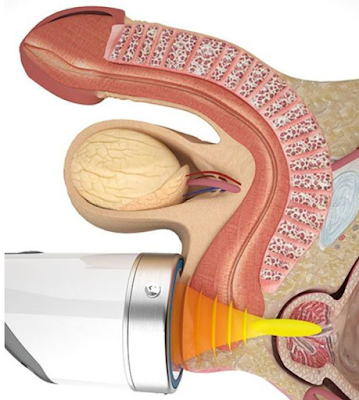 體外震波經由皮膚將能量傳遞至攝護腺