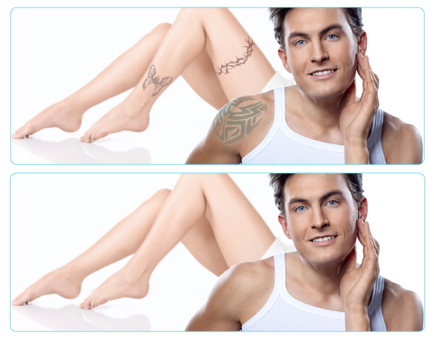 Laser tattoo removal is a safe and effective treatment that makes tattoos of