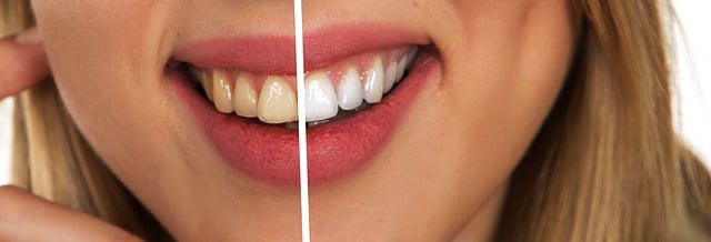 पीले दांतों को सफेद कैसे करें