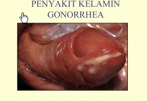 obat kencing nanah yang dijual di apotik  