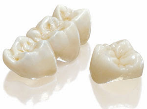 Bellevue Dentist Porcelain Crowns