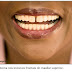 Diastema é um defeito nos dentes?