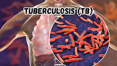 Tuberculosis (TB)