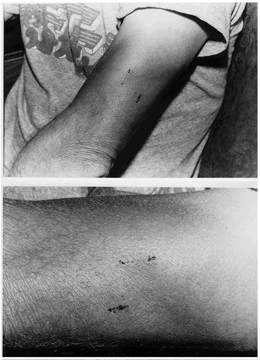 The ‘puncture wounds photos of Charles Hickson’s arm and in close-up