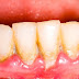 Cao răng là gì? Vì sao phải cao sạch cao răng?