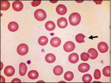 photo of glucose-6 phosphate dehydrogenase deficiency, foto Defisiensi G-6PD pada anemia hemolitik