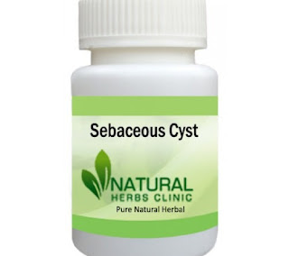 Herbal Product for Sebaceous Cyst
