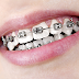Trường hợp móm răng nhận biết thế nào?