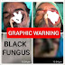 Scary Visuals of First Death from Black Fungus in Mysore, Karnataka (Graphic Warning) 