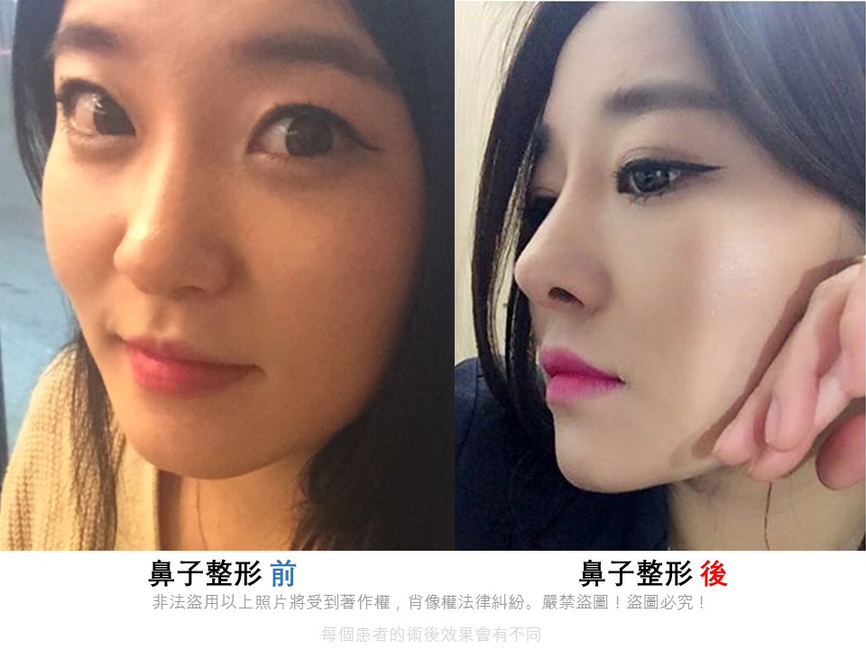 凱奇美女公主日記catch Meinv 韓國隆鼻整形案例 我適合哪一種鼻型整形呢